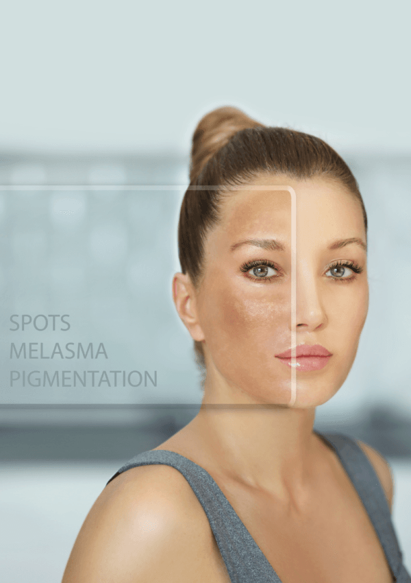 Confronto del viso di una donna che mostra macchie cutanee come melasma e pigmentazione da un lato e pelle uniforme dall'altro.