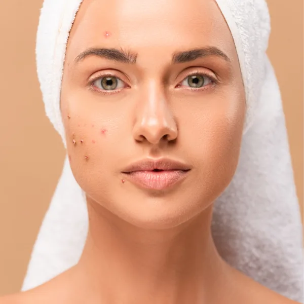 Acido tranexamico: l’attivo che aiuta a ridurre le macchie senza irritare